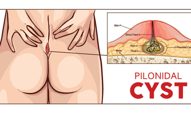 TVILLING: En cyste som oppstår øverst, mellom rumpeballene. Kan bli svært vond hvis den blir betent. bIllustrasjon: NTB 'Scanpix/Shutterstock TVILLING: En cyste som oppstår øverst, mellom rumpeballene. Kan bli svært vond hvis den blir betent. bIllustrasjon: NTB 'Scanpix/Shutterstock